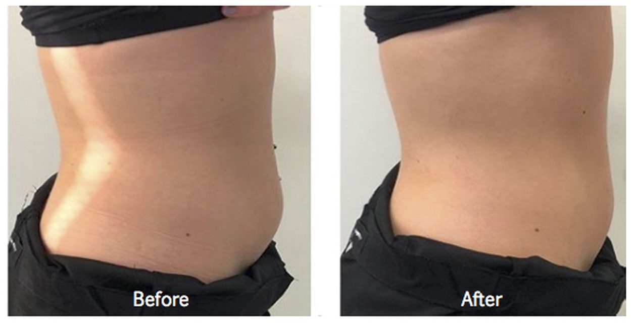 Fat cavitation before and after, abdomen