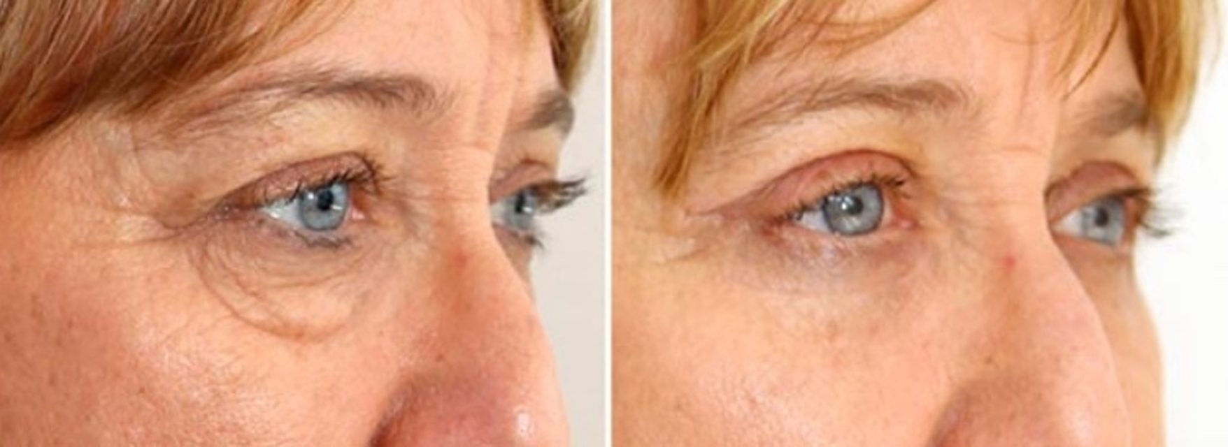 Plasma fibroblast eyelid lift before and after