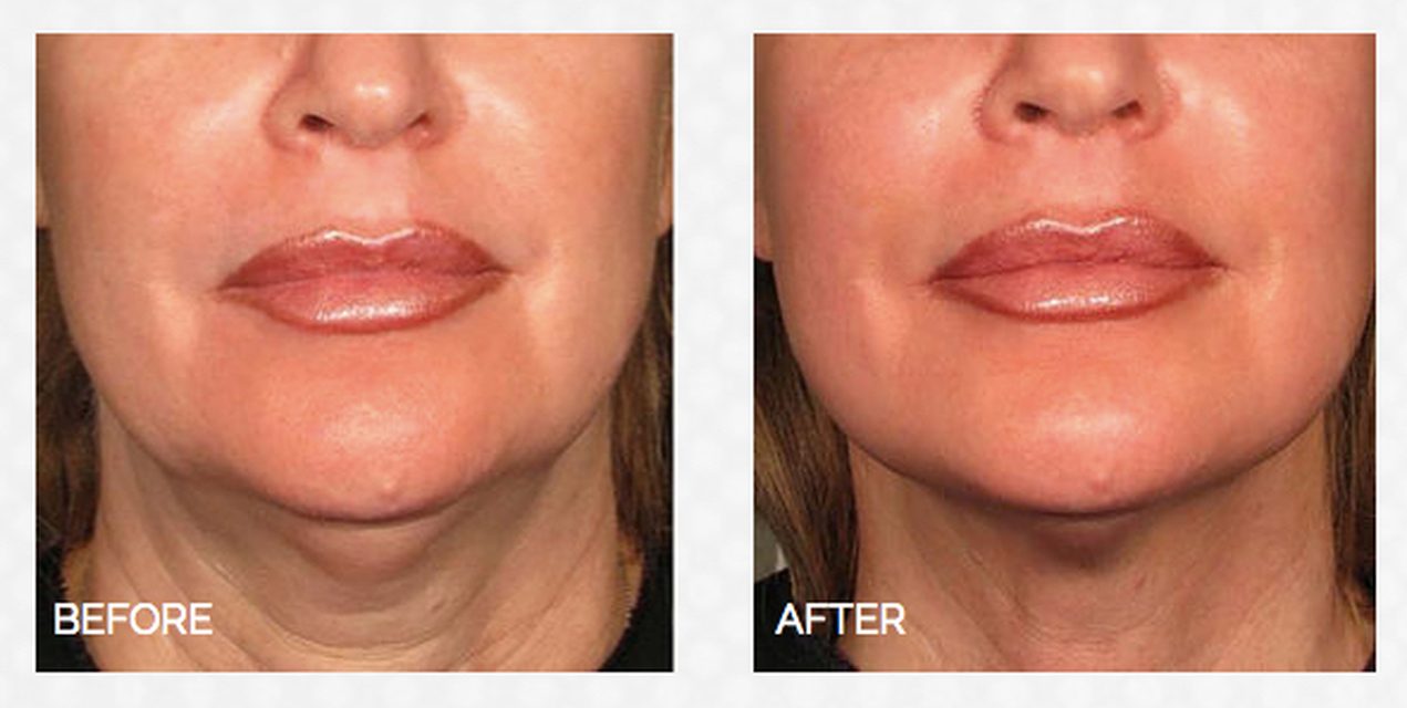 HIFU skin lifting before and after, lower face