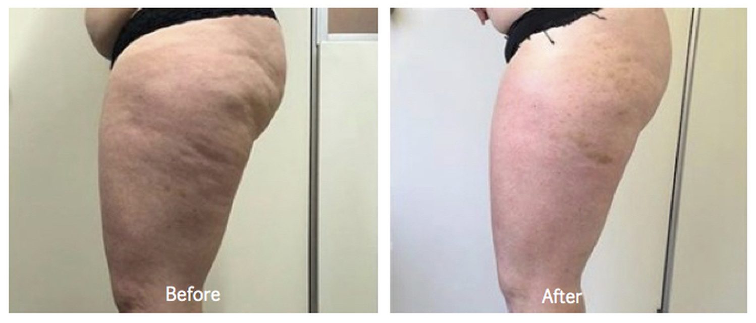 Cellulite and inch loss before and after, thighs