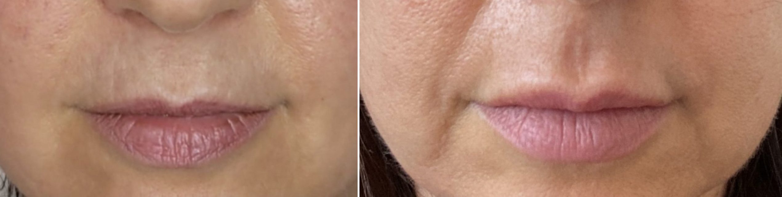 Lip lines before and after