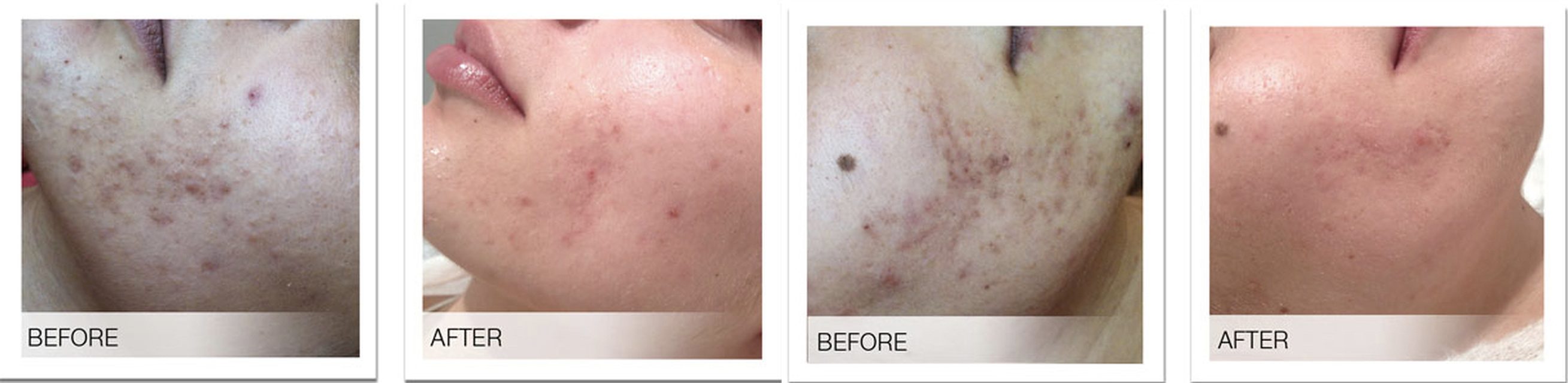 Skin corrections before and after